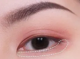Garis putus-putus di garis bulu mata bawah