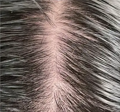 Belahan rambut tipis dengan kulit kepala terlihat sebelum memakai Therapy Serum
